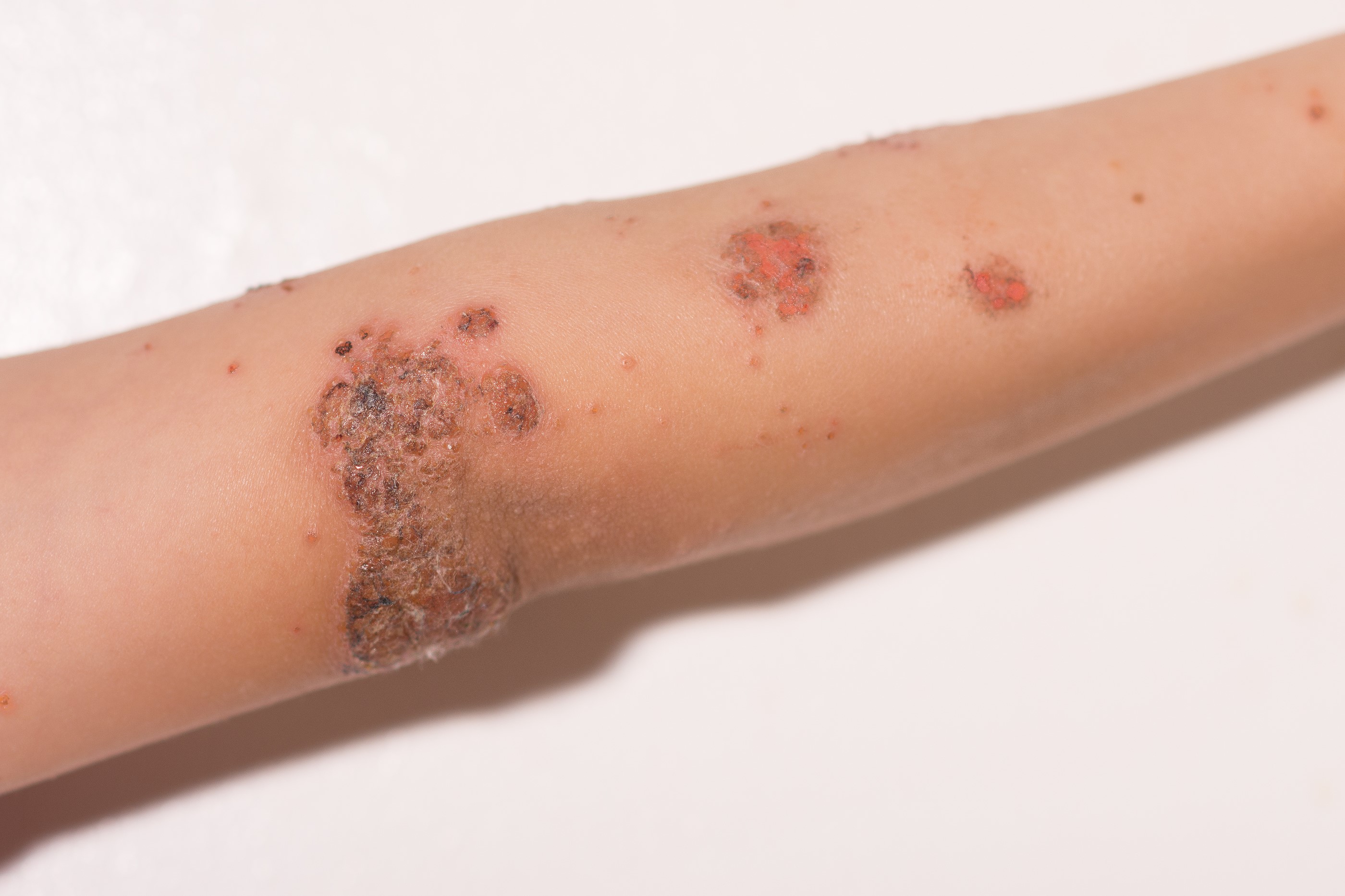 Impetigo: Formy, příznaky a léčba