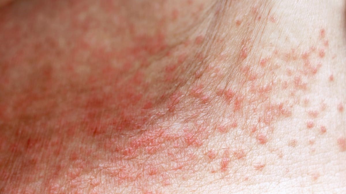 Potničky: Příčiny, příznaky a léčba