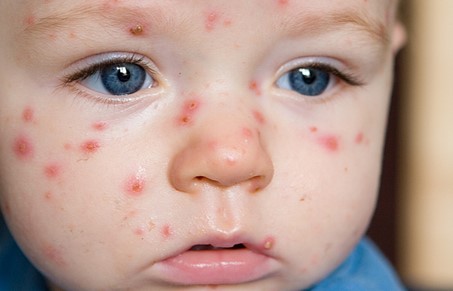 Plané neštovice: Příznaky, inkubační doba a přenos