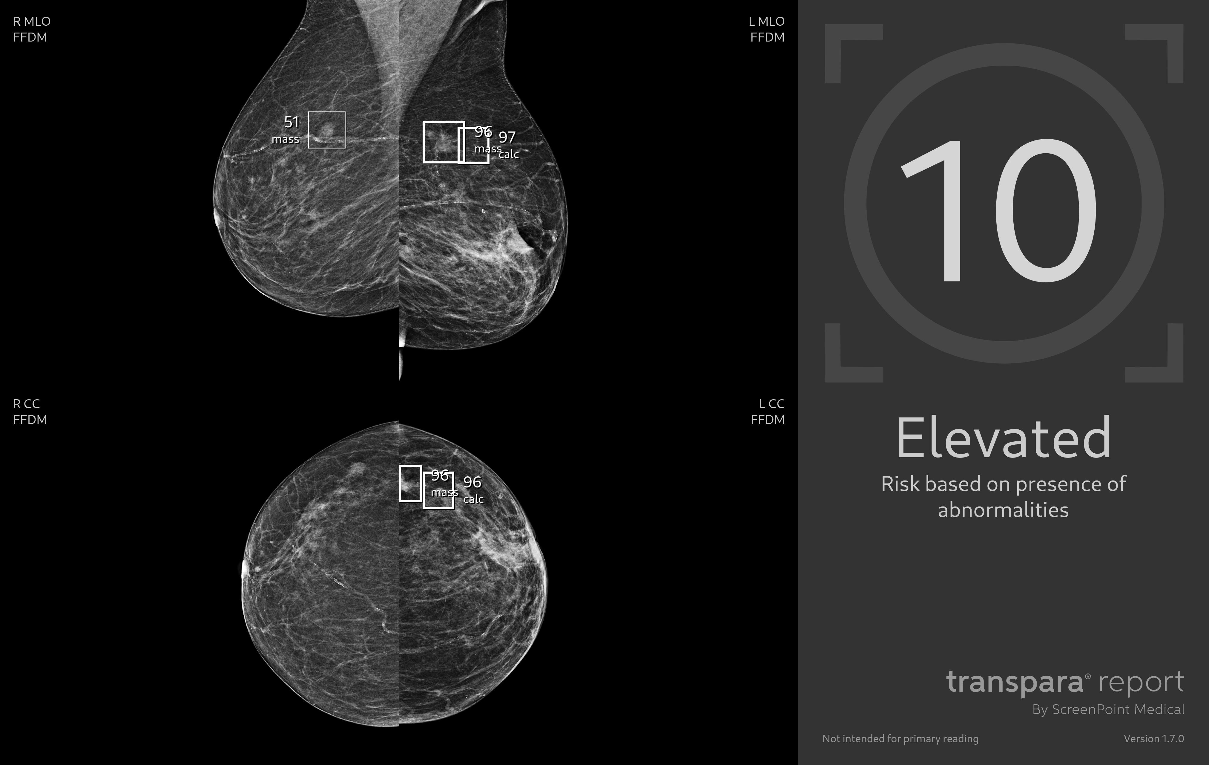 OZP klientkám jako první hradí unikátní mamografické čtení snímků pomocí umělé inteligence.