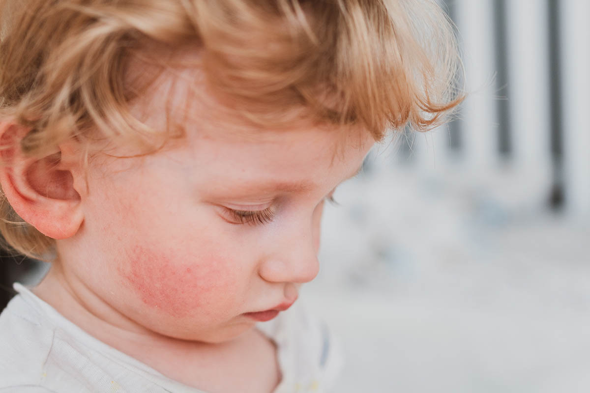 Impetigo: Formy, příznaky a léčba
